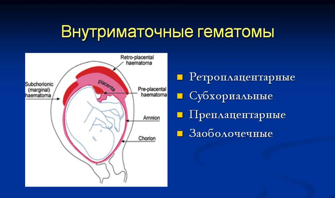 Гематома в стадии организации. Субхориальная гематома. Ретроплацентарные гематомы. Гематома при беременности. Ретрооболочечная гематома.